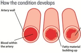 Blocked arteries