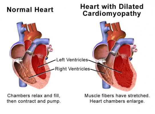 Cardiac Arrest, heart attack