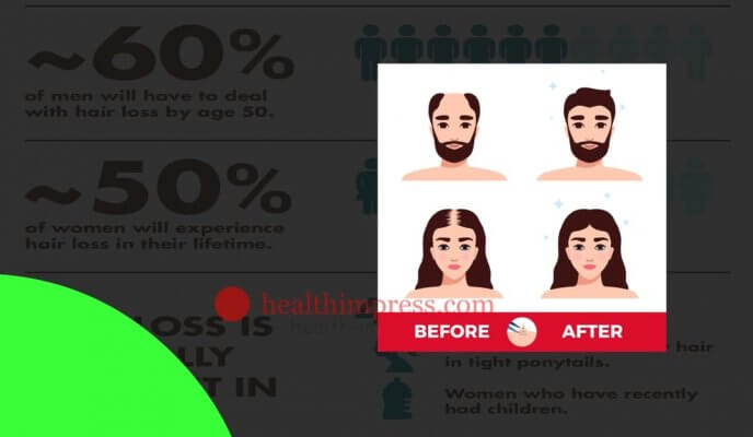 Hair Loss Statistics & Categories Health Impress