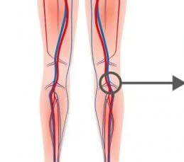 Definition and Types of Thrombosis