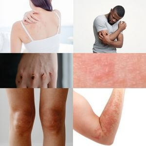 Contact dermatitis pictures