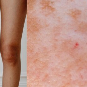 What is contact allergy